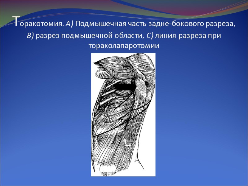 Торакотомия. А) Подмышечная часть задне-бокового разреза, В) разрез подмышечной области, С) линия разреза при
